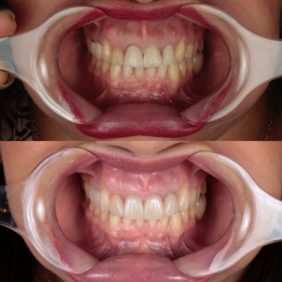 Sorriso radiante com clareamento dental de alta performance