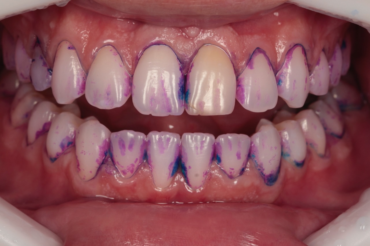 Procedimento de restauração estética em resina
